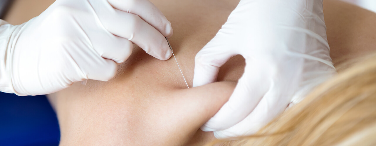 Dry Needling Lansing, Okemos, Dewitt, Mason & Waverly, MI