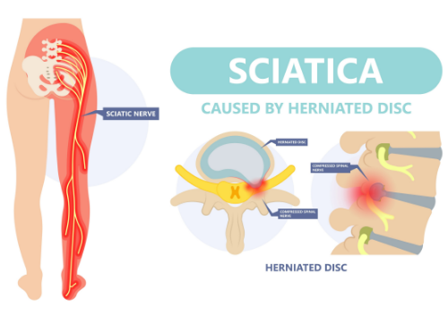 sciatica-pain-relief-peak-performance-dewitt-mason-lansing-mi